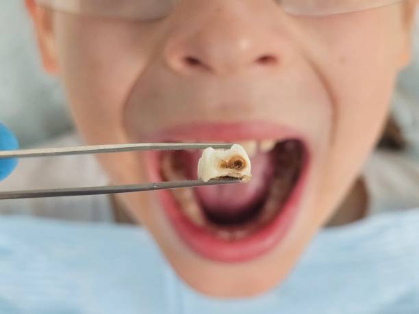 Best Emergency Wisdom Tooth Extraction in Rolling Hills Estates, CA